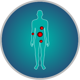 Patients in: Generalized Advanced Stage